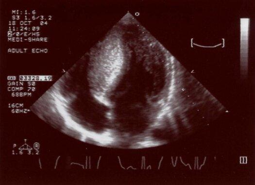 Echocardiogram