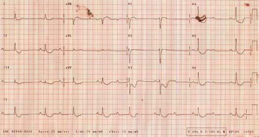 ECG of February