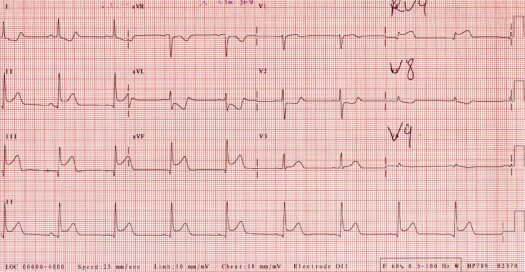 ECG of February