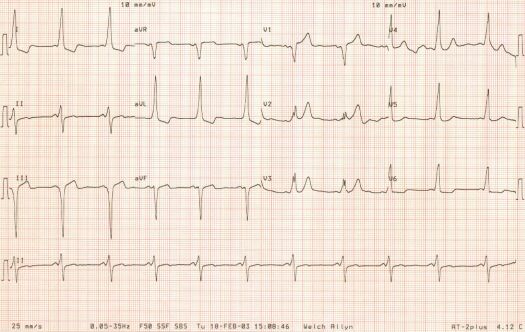 ECG of March