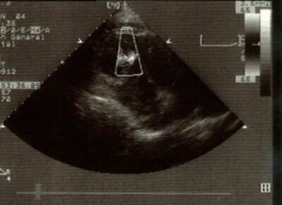 Echocardiogram