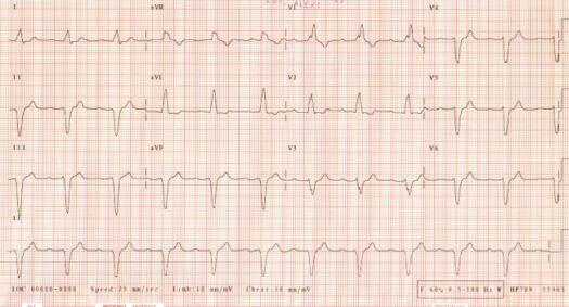 ECG of April