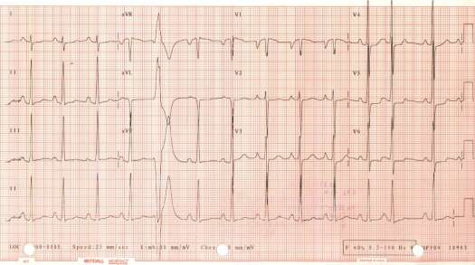 ECG of April