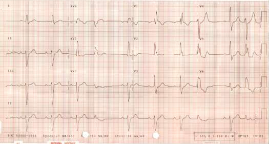 ECG of May