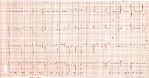 ECG of June