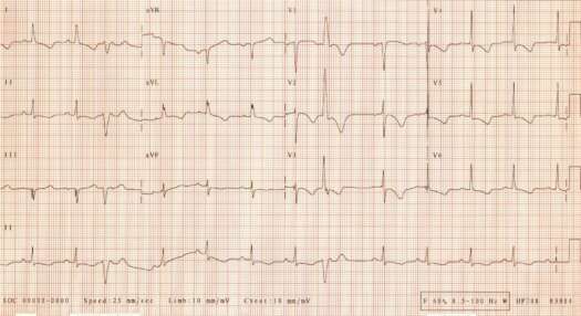 ECG of July