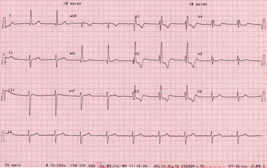 ECG of July