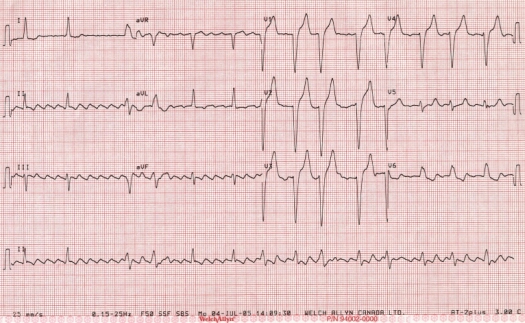 ECG of August