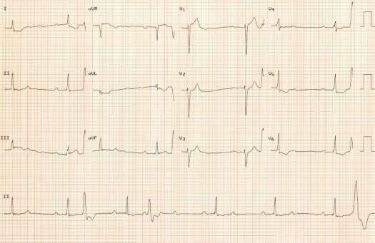 2nd ECG of September