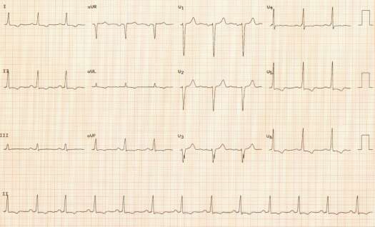 1st ECG of September