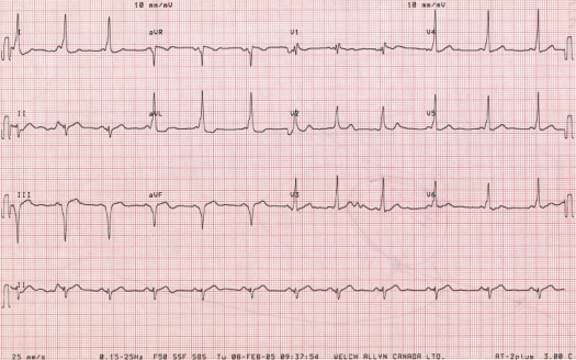 ECG of September