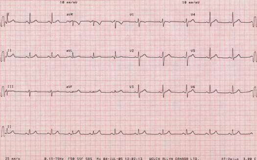 Second ECG of September