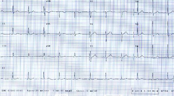 ECG of October