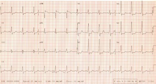 2nd ECG of October