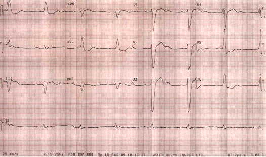 ECG of October