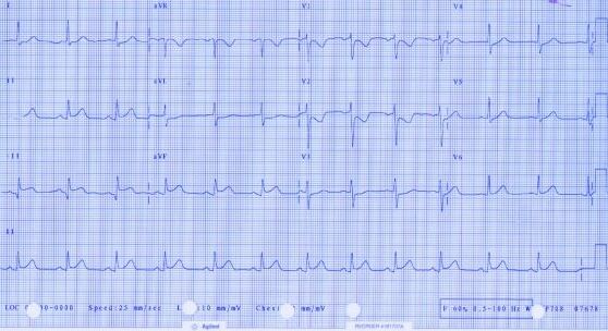 ECG of November