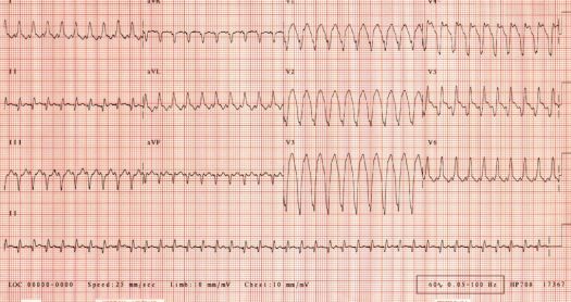 1st ECG of November