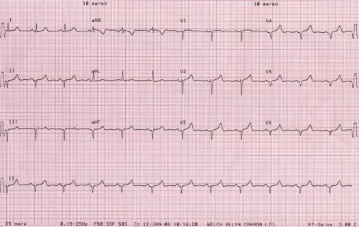 ECG of November