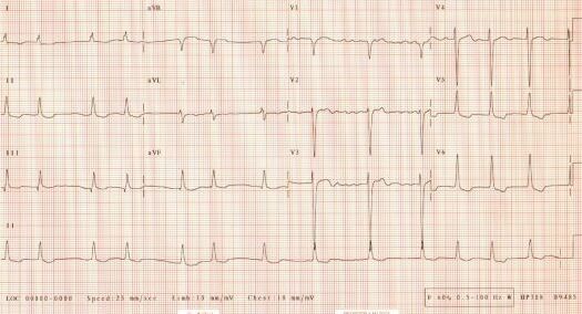 ECG of December