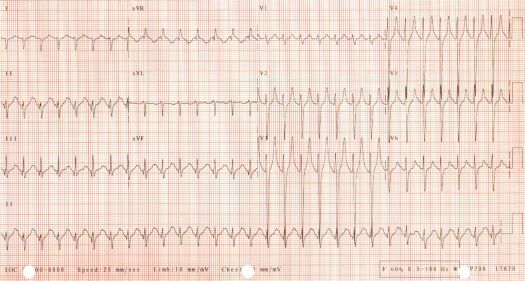 1st ECG of December