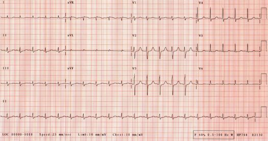 2nd ECG of December