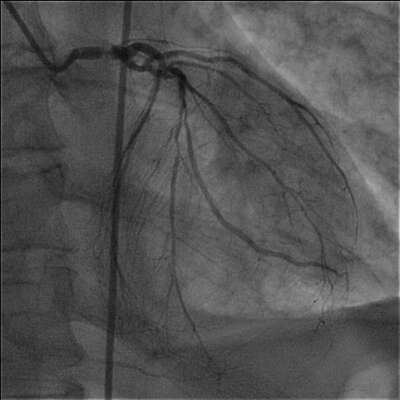 Stenosis left main image 1