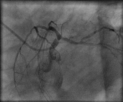 Stenosis left main image 2